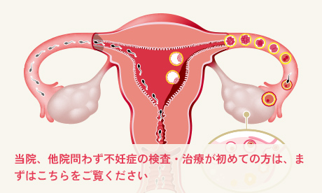 不妊症と不妊治療について